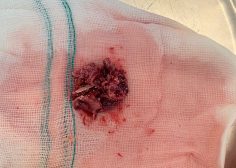 MV cleaning with LA size reduction