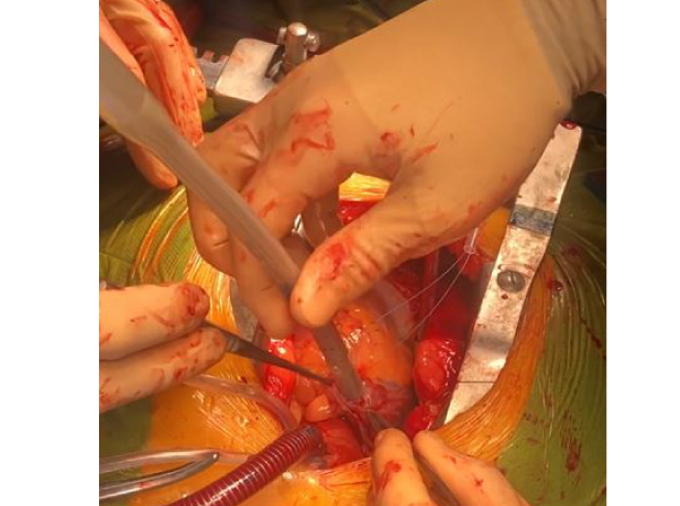 foto-Canulacion-venosa-arre1