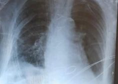 Severe Mitral stenosis and diaphragmatic hernia