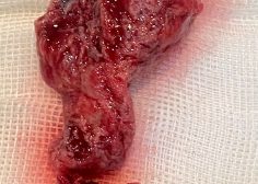 Trans septal mass excision