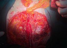 redo surgery and débridement and omental flap from infra diaphragm